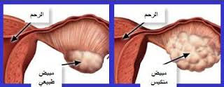 مبايض ,تقويه المبايض ,اعشاب تقويه المبايض,