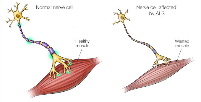 Amyotrophic Lateral Sclerosis Market Projected to Deliver Greater Revenues during the Forecast Period 2021-2027