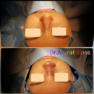 Micromotor Assisted Revision Nose Job, Micro-Motor Assisted Revision Rhinoplasty Operation,Revision Nose Aesthetic Operation in Turkey,