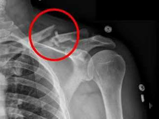 köprücük kemiği röntgen