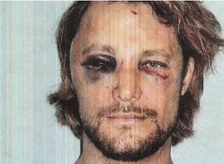 Gabriel Aubry com rosto desfigurado após briga. Foto: AP