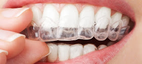 نصائح بعد تبييض الاسنان بالليزر