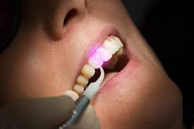 Laser Dentistry: A New Treatment Modality