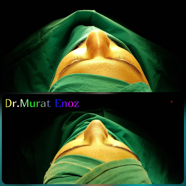 Rhinoplasty in men Istanbul - Male nose job Turkey