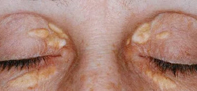 Cara Menghilangkan Gumpalan Lemak Di Kelopak Mata ( Xanthelasma ) Dengan Obat Herbal Alami