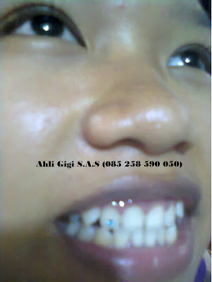 Cewek Gingsul Manis dengan Tooth Diamond Permata Gigi 