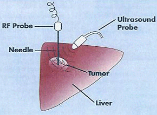 liver Radio Frequency  ablation Specialist, liver RFA, Liver rfa procedure, Affordable Price Radio Frequency Ablation liver Surgery in Ahmedabad, liver RFA Surgery in gujarat