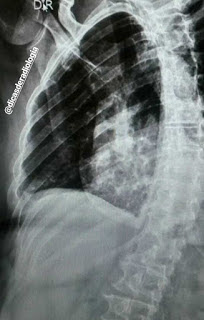 Exames de Imagem de raio x mostrando fratura de costela