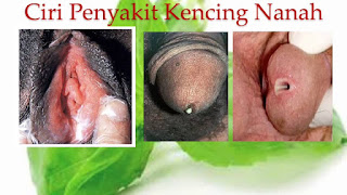 Berapa Harga Obat Kencing Nanah Gangjie Ghosiah Di Jakarta