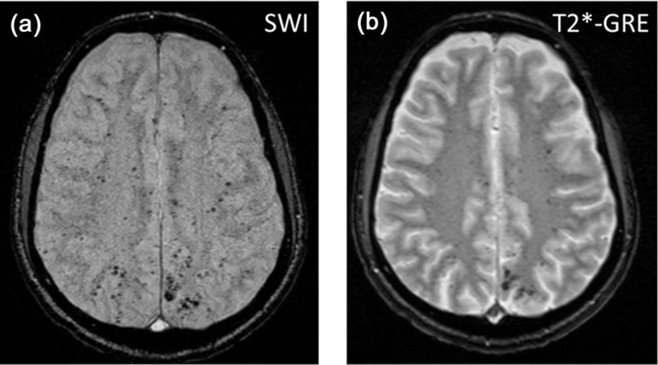 Magnetic Resonance Innovations Research Blog: Cerebral Microbleeds