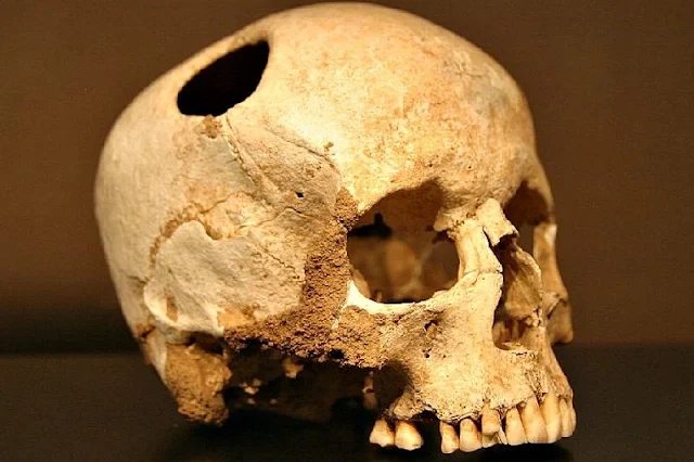 Cirugía de trepanación craneana descubierta en oriente próximo