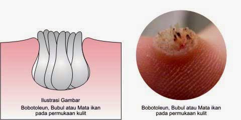 ZaiN tioN Mata Ikan VS Bawang Putih