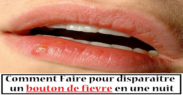 bouton-de-fievre-herpes-labial