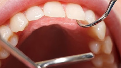 Cạo vôi răng mất bao lâu là sạch? 2