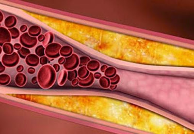 Arteriosclerosis Definition : What Is Arteriosclerosis