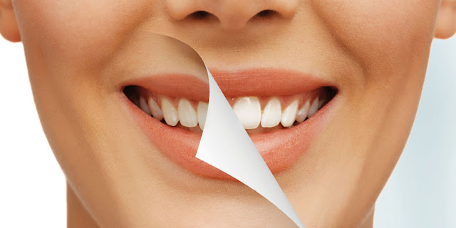 teeth whitening merrylands, teeth extractions merrylands
