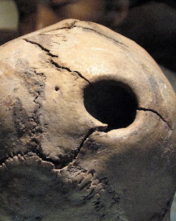 5,000 Years Ago Skull Surgery A Success