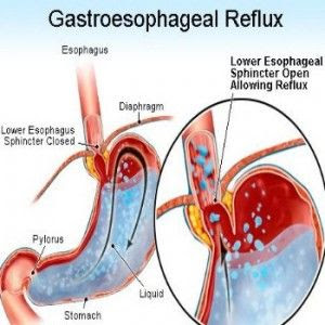 Ubat Gastrik Angin