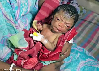 A Baby Has Been Born That Looks Like A 80-Year-Old Man (PHOTOS)