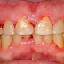 Nguyên nhân chảy máu răng là gì?