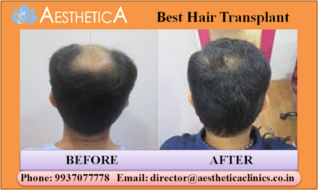 Best Hair Transplant 