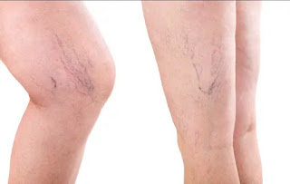 Are some women more at risk of varicose veins and spider veins?_ichhori.webP