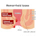 Types of Hemorrhoids - Causes, Symptoms & Treatments