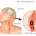 Mengenal Gejala Penyakit Stroke