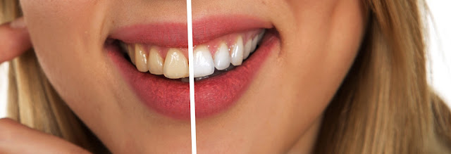 how to whiten teeth naturally, how to whiten teeth at home in one day, how to whiten teeth instantly, how to whiten teeth with lemon, how to whiten teeth, best teeth whitening kits, how to whiten teeth with baking soda, teeth whitening methods, how to get white teeth in 1 day