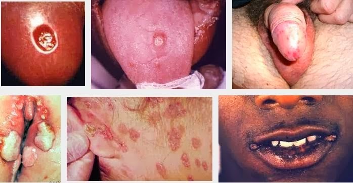 obat tradisional penyakit sipilis pada wanita, ciri sakit sipilis, gejalah sipilis