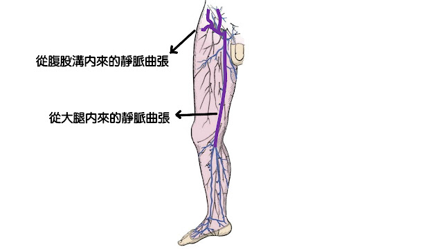 腹股溝及大腿內靜脈曲張血液逆流來源示意圖