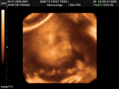 3d ultrasound pictures. 3d ultrasound pictures at 20