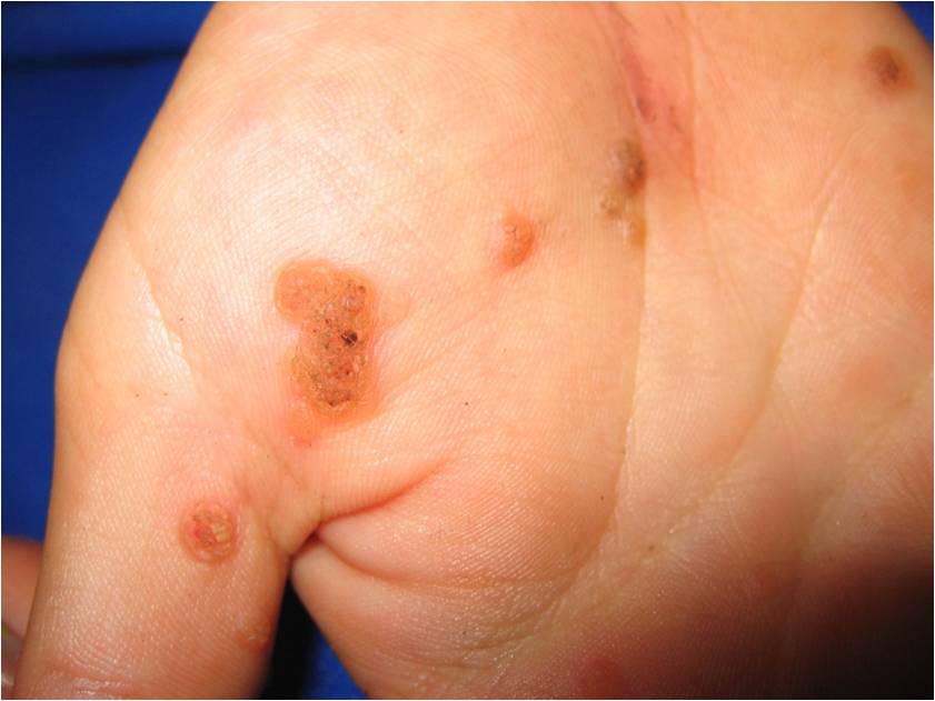 common wart images. Common Warts