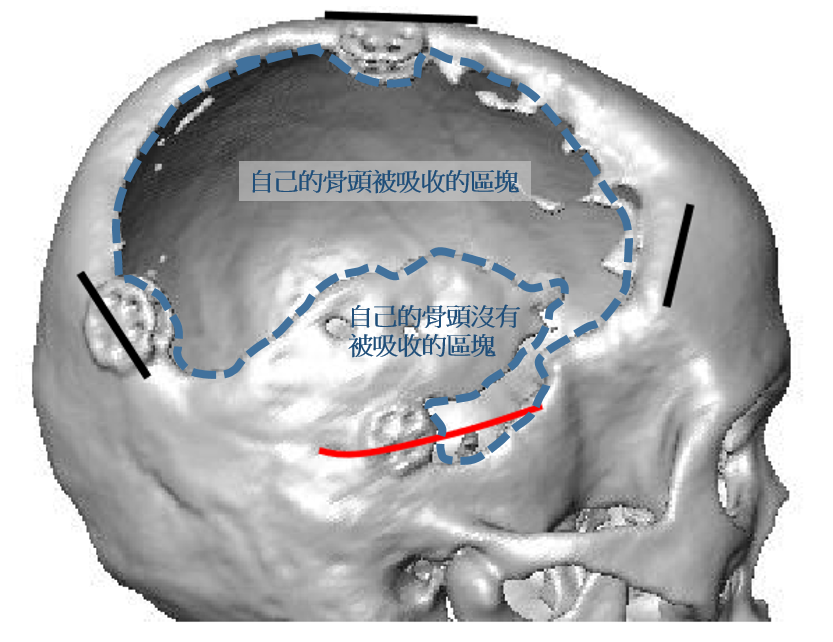 Mr Shih 施育彤醫師 開刀裝回自己的頭蓋骨也可能被吸收掉