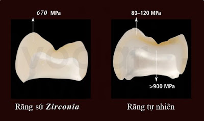 Chi phí thực hiện răng sứ Zirconia