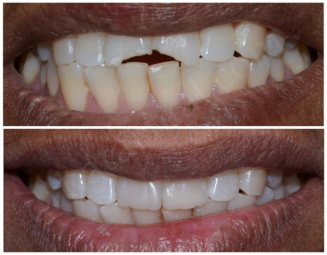 Broken Front Teeth Restored at Dr. Bharat Katarmal Dental Clinic Jamnagar