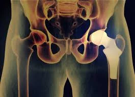 Hip replacement