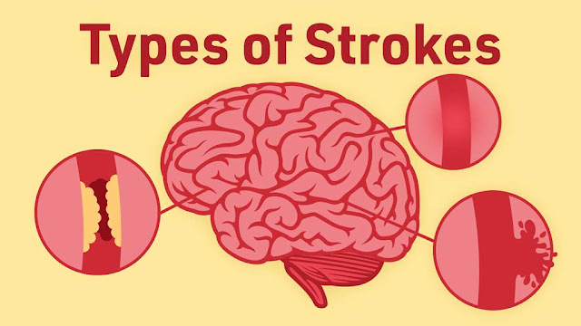 Type of Strokes