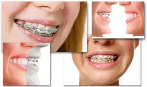Kỹ thuật niềng răng người lớn là gì?