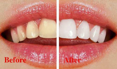 Tẩy trắng răng có đau không?