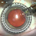 Limbal relaxing incisions