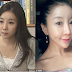 Korean woman ruins her beautiful face with shocking Plastic surgery procedure 