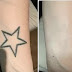 Tattoo Removal - The Low-Cost Way