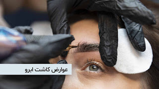 Complications of eyebrow transplant