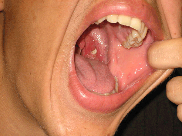 Tonsillolith in mouth