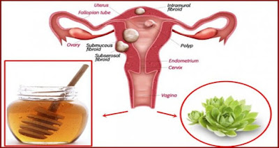 Mix These 2 Ingredients And Destroy Any Cysts And Fibroids