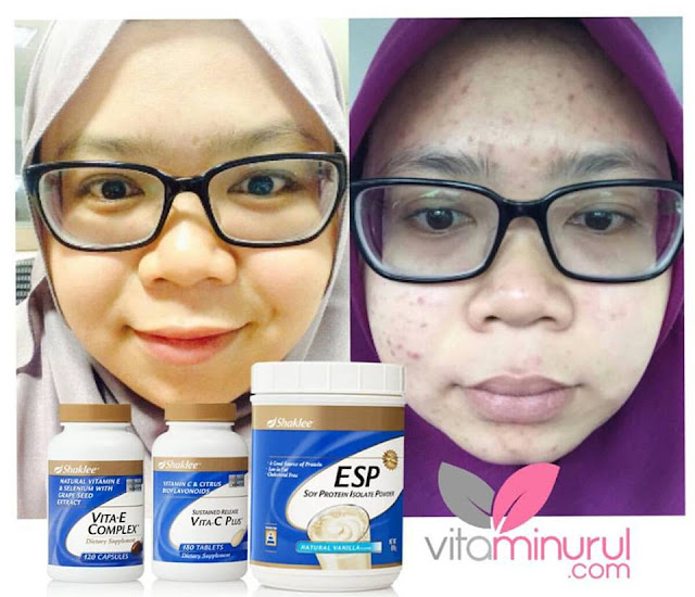 rawat jerawat dengan vitamin c shaklee