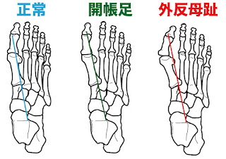 開張足が悪化しているメカニズム。詳細は後述。