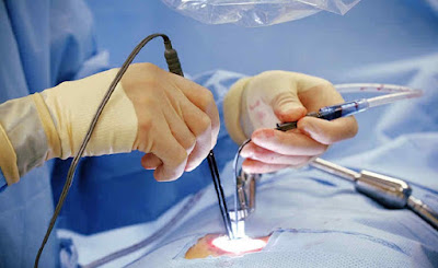 Minimally invasive Spine Surgery in Telangana