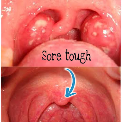 What is an aggravated throat? And 8 explanations behind sensitive throats.